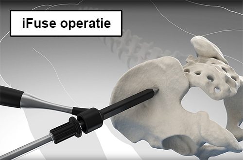 Ifuse operatie si gewricht