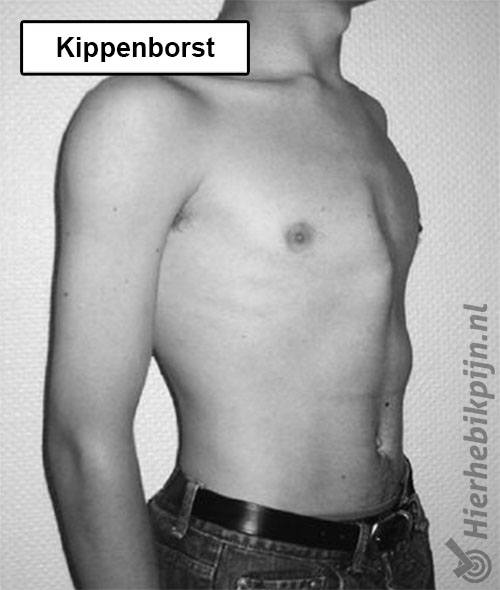 Kippenborst pectus carinatum