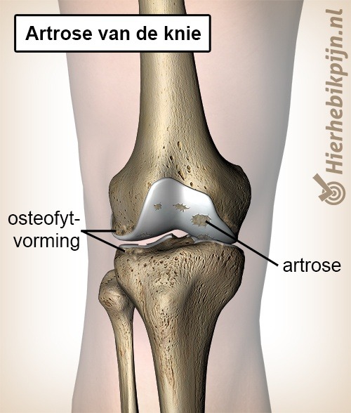 Knie artrose kraakbeen slijtage osteofyten osteofytvorming