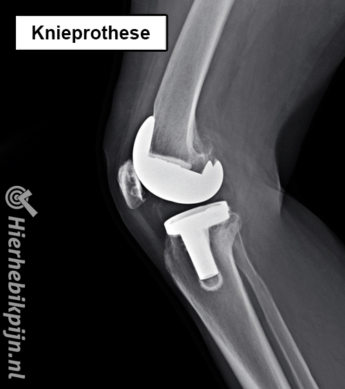 Knie prothese rontgenfoto hele knieprothese kunstknie nieuwe knie zij aanzicht
