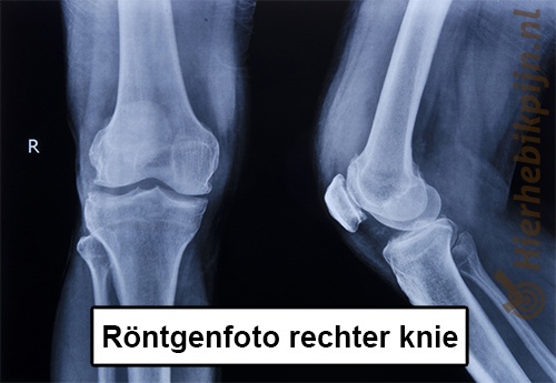 Knie rongtenfoto