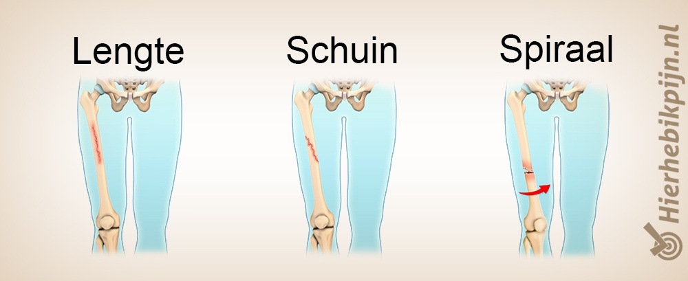 Lengte schuin spiraal breuk
