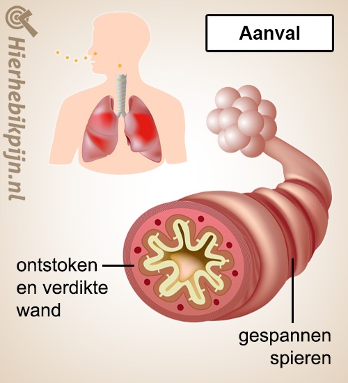Longen astma aanval anatomie