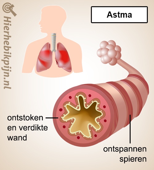 Longen astma anatomie