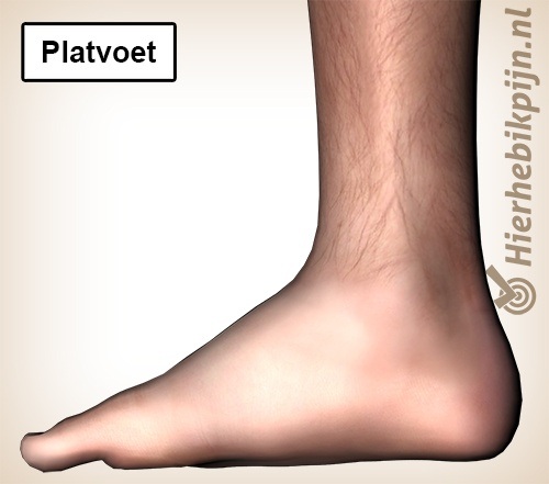 Platvoet mediaal binnenkant pes planus