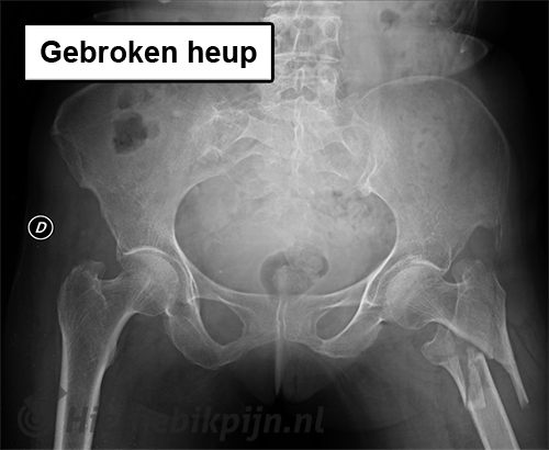 Rontgenfoto gebroken heup fractuur
