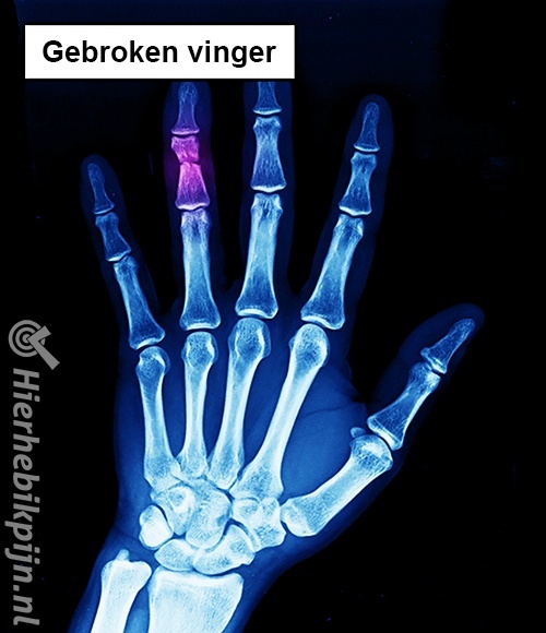 Rontgenfoto gebroken vinger fractuur