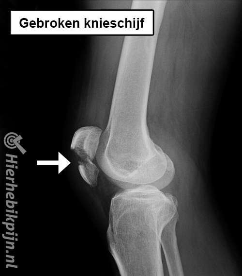 Rontgenfoto knie gebroken knieschijf patella fractuur
