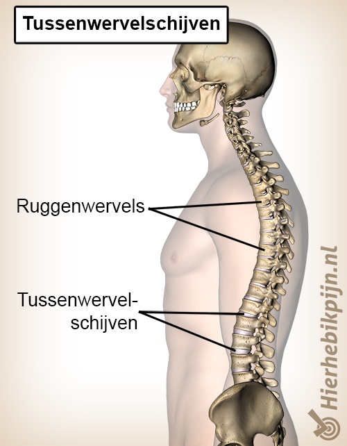 Ruggenwervels tussenwervelschijven