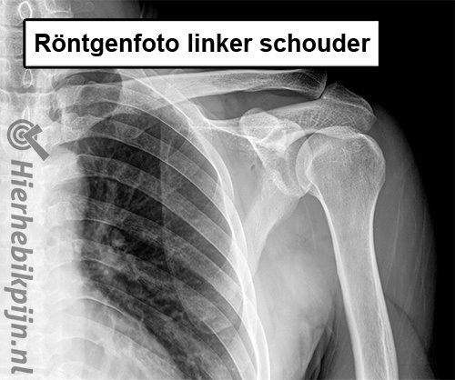 Schouder rontgenfoto