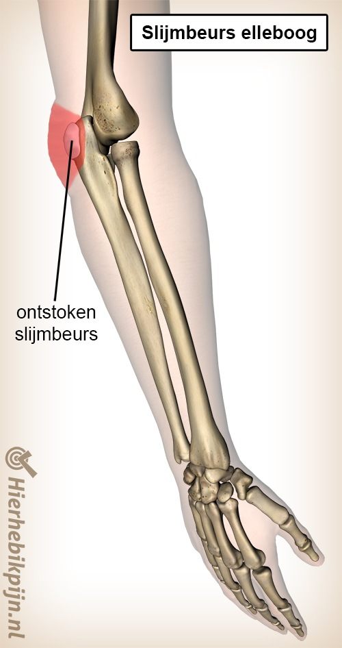 Slijmbeurs ontsteking elleboog bursitis olecrani
