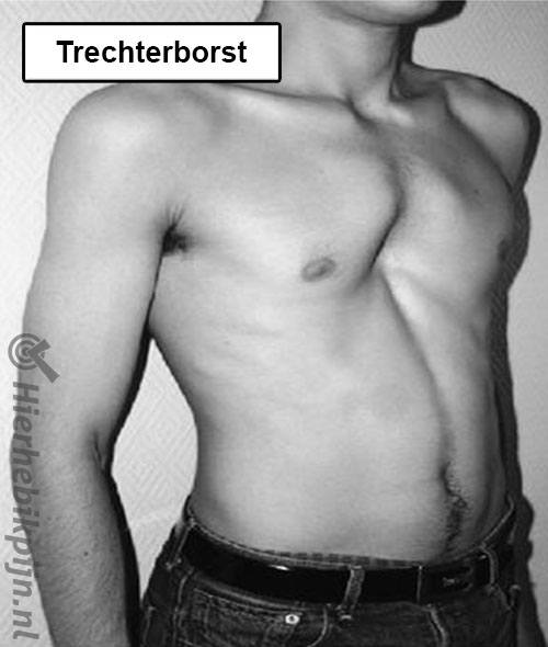 Trechterborst pectus excavatum