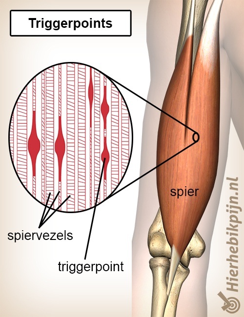 Triggerpoint spier myofasciale triggerpoints spiervezels