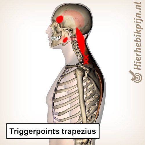 Triggerpoints spier trapezius