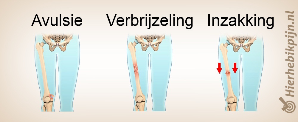 Verbrijzeling avulsie inzakking breuk 3