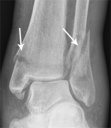 Voet enkel fractuur rontgen