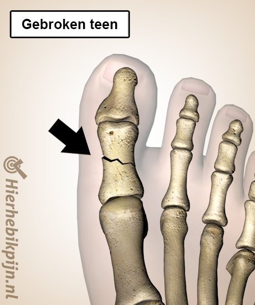 Voet gebroken teen grote teenfractuur